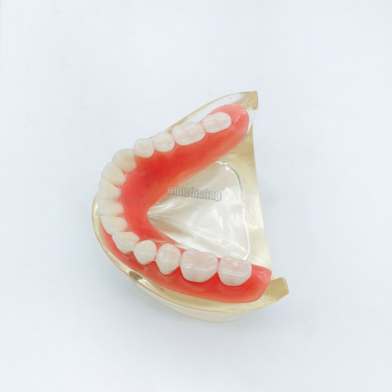 Two types of doctor-patient teaching models with explants for removable mandibular denture models