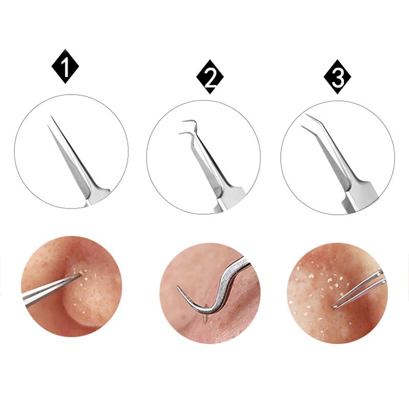1pc roestvrijstalen hulpmiddelen voor het verwijderen van mee-eters, mee-eters en puistjes.