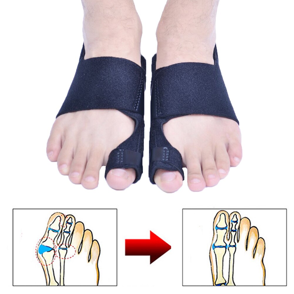 1 Paar Grote Teen Hallux Valgus Corrector Orthotics Voetverzorging Bone Duim Richter Correctie Pedicure Bunion Stijltang