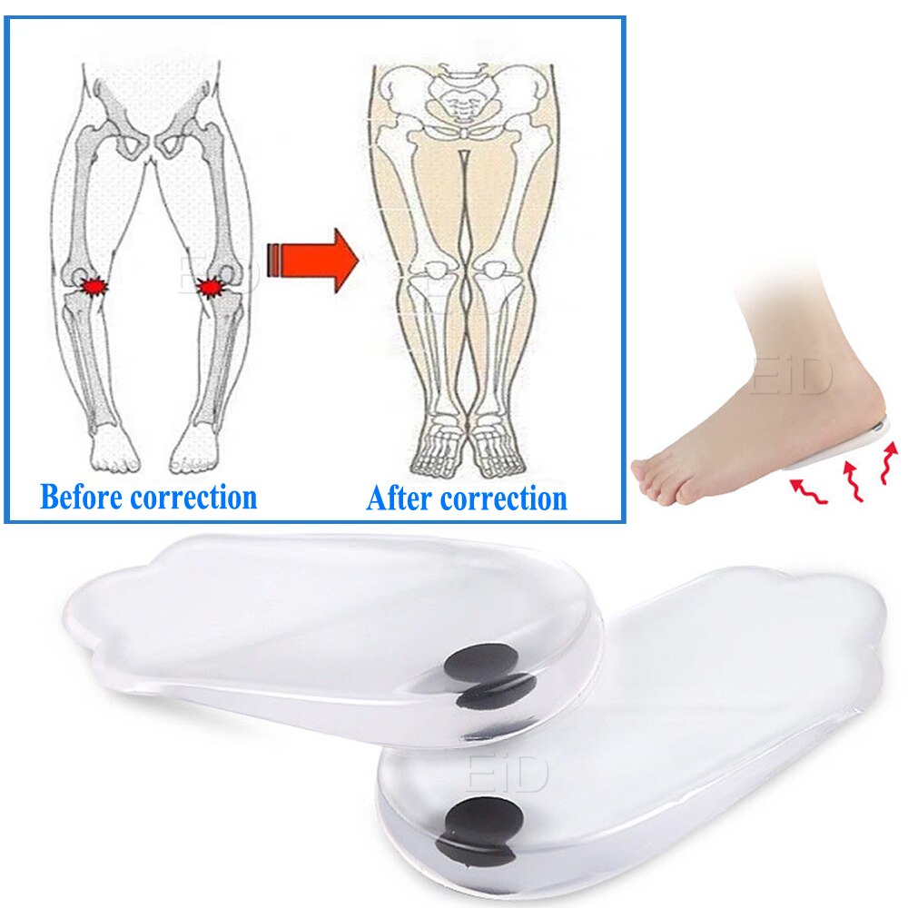 EiD Silicone Gel Orthotic Heel Pad for XO Legs orthopedic Varus Correct Plantar Fasciitis Pain Relief Foot Care Insert Insoles