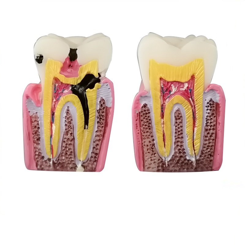 6Ttimes Cariës Comparation Tanden Model M4021 Tonen Normale Anatomische Oppervlak Van De Tand/Dental Onderwijs Model M4021