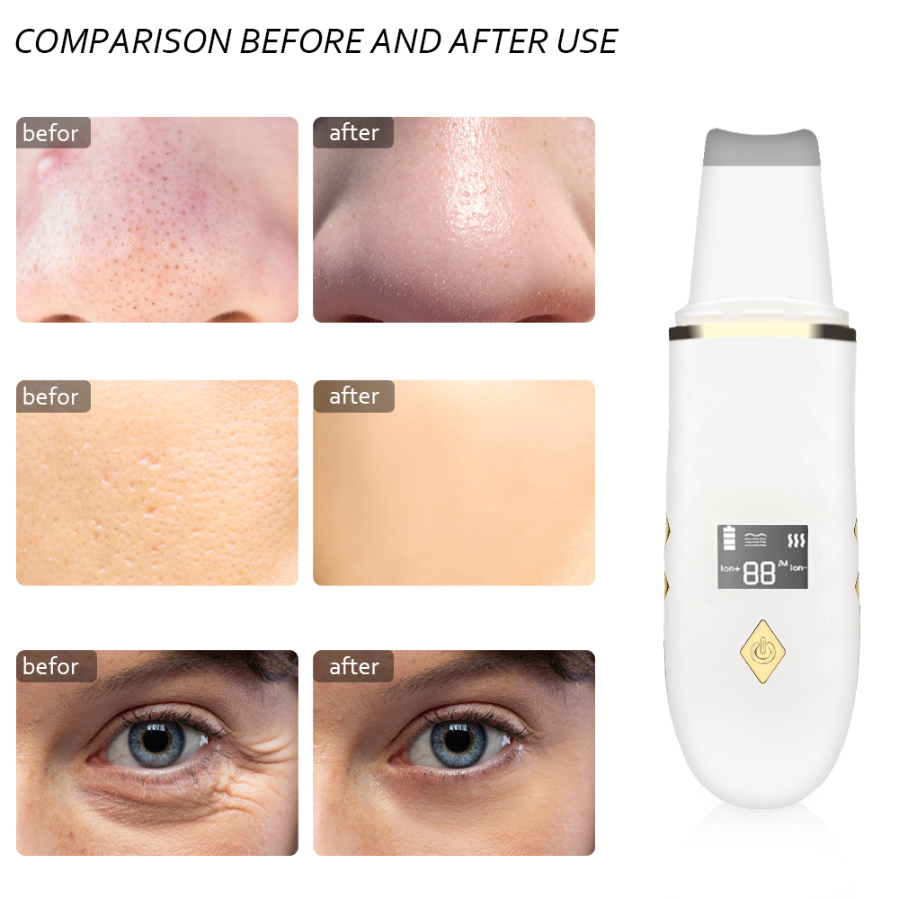 Espátula ultrasónica para limpieza Facial, Extractor de espinillas, herramienta de limpieza Facial,