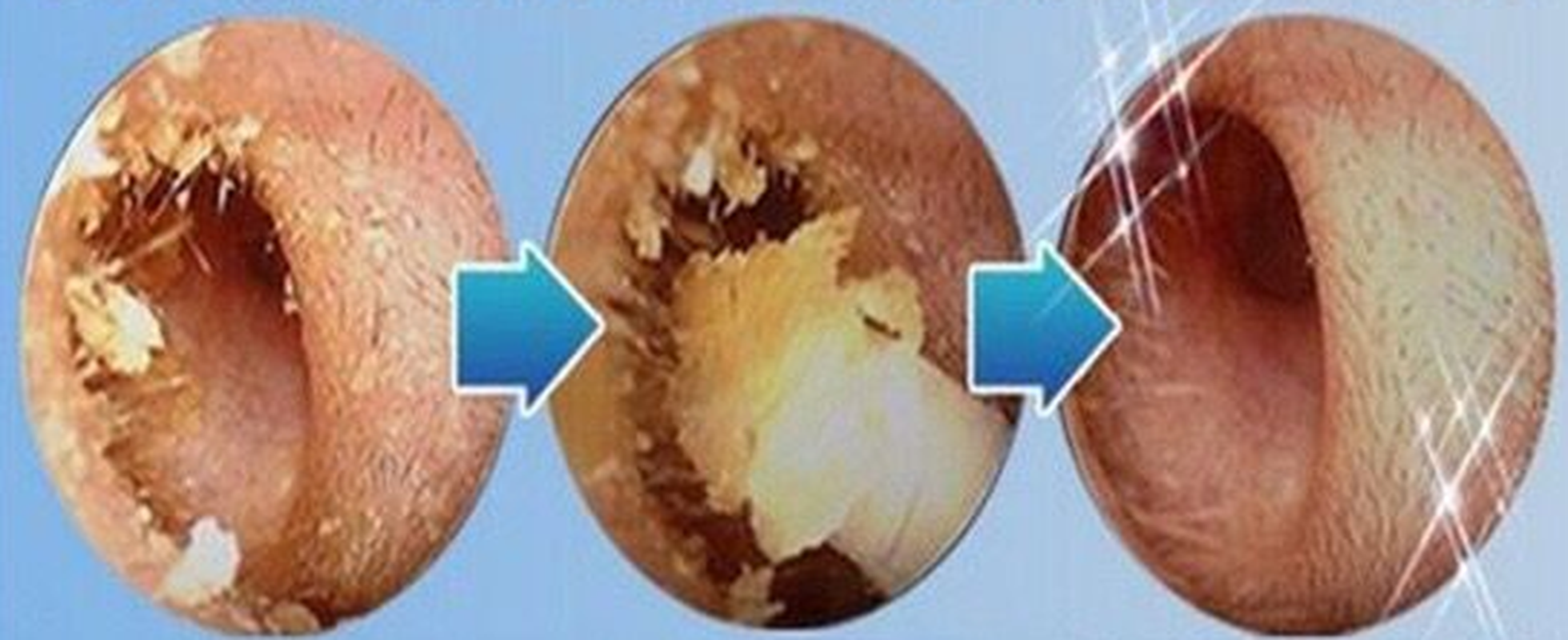 Blue Comfortable Ear Wax Cleaner Electric Cordless Vacuum Ear Cleaner For Ear Safe Remover Cleaning Tool