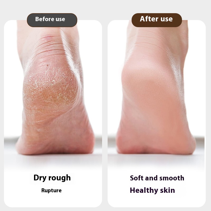 Elektrisk fotslip, hälpeeling och förhårdnader, fotreparationsapparat