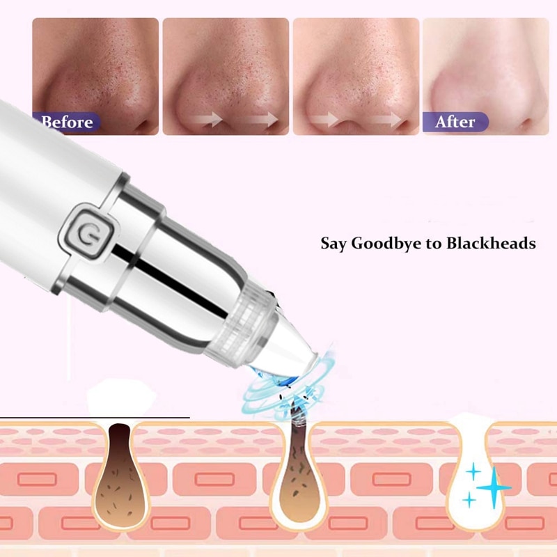 Face Blackhead Removal Vacuum Cleaner-Battery Operated Pore Cleaner Blackhead Removal Tool with 4 Replaceable Suction Cups for B: Default Title