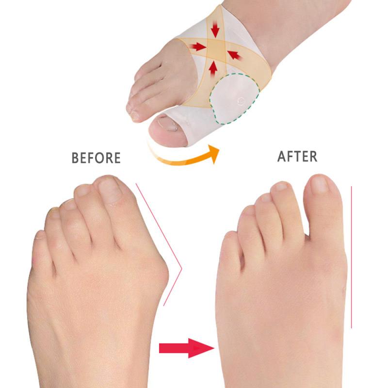 Isovarvas päällekkäisyys silikoni hallux valgus korjain varpaan erottimet nuppi korjaimet jalka sormi halkaisija varpaan suoja ortoosi