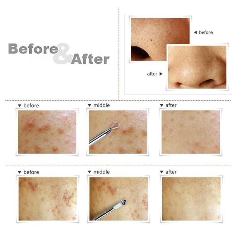 Agujas para quitar espinillas y acné, limpiador de puntos negros, herramientas de belleza para el cuidado de la piel, Unisex, T6E1