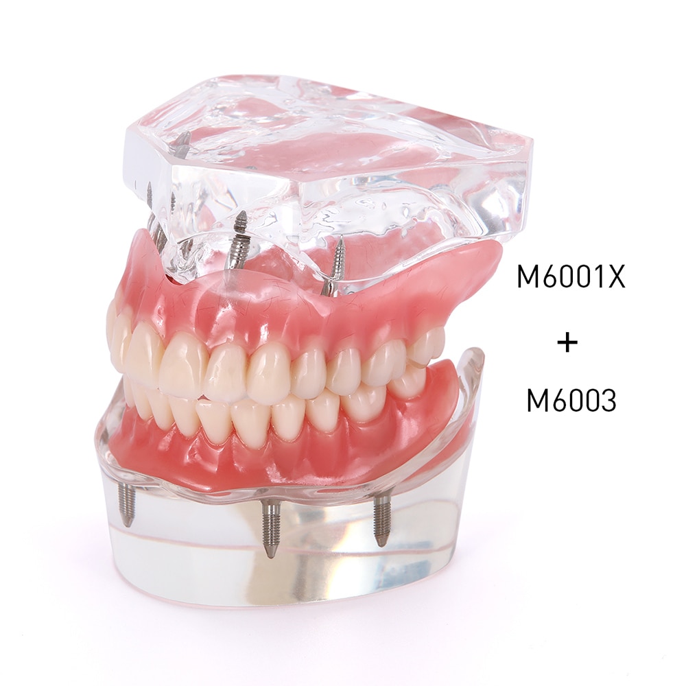 Dental Implant Teeth Model Removable Interior Mandibular Demo Overdenture With Implants upper/Lower for Tooth Teaching Study