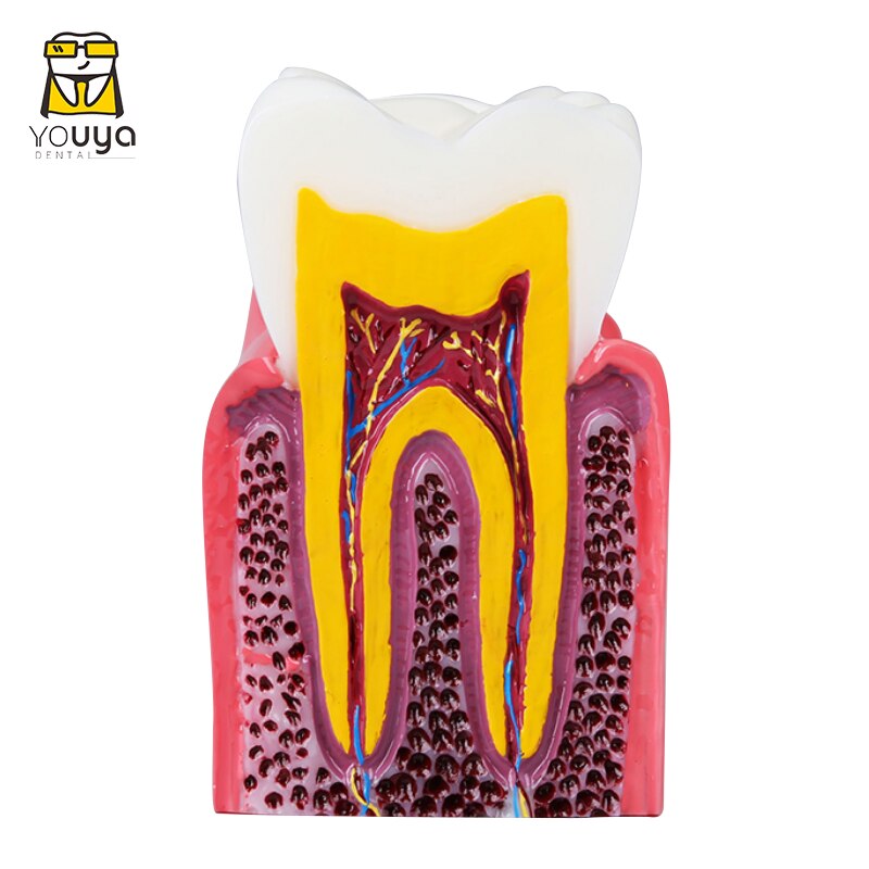 6 Times Dental Model Molar Pathological Anatomic Comparison Model To Facilitate The Study Of Tooth Structure And Lesion Process