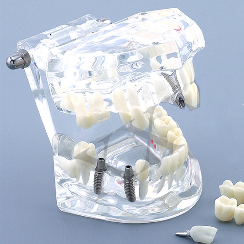 Dental Implantat Restaurierung zähne Modell M2001 Dental lehre zahn modell/Dental Labor Klinik zähne modell: White