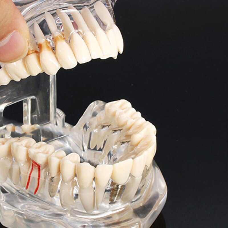 Tandheelkundige Restauratie Tanden Model Transparante Implant Disedental Implant Ziekte Tanden Model Met Restauratie Brug Tand Tandarts