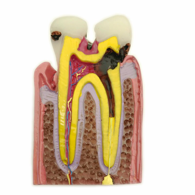 1pc Dental Anatomy Education Teeth Model 6 Times Caries Comparation Study Models For Dentist Studying and Researching