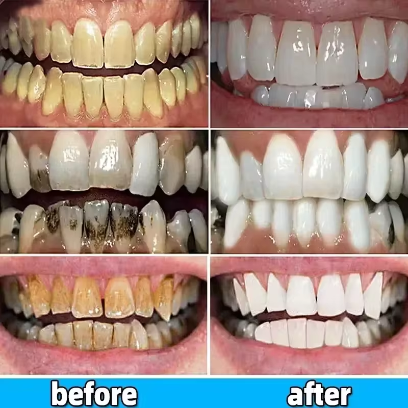 120 g probiotische Karies-Zahnpasta SP 4 aufhellende Zahnkaries-Reparaturpaste, Zahnreiniger, Plaque-Entferner, frischer Atem, Zahnpflege