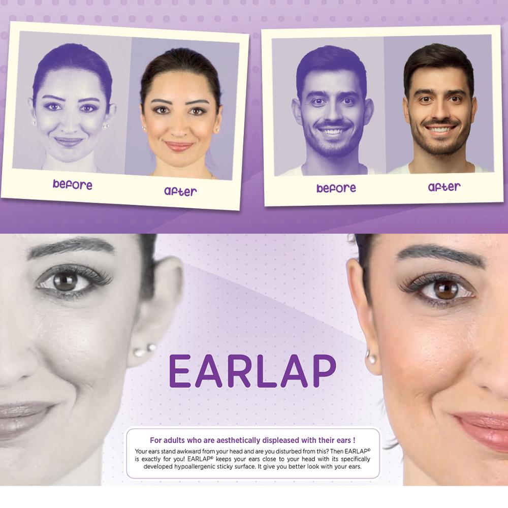 EARLAP Ear Corrector Tapes for Protruding Ears . Suitable for newborns and adults. Otostick. Arrilis Best Ear Corrector