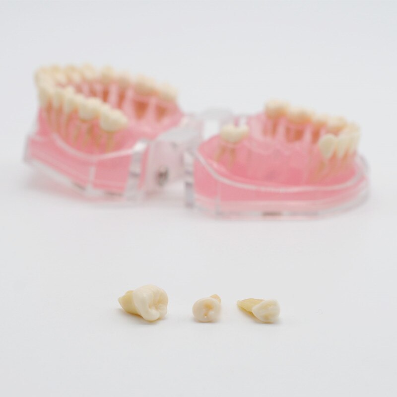 Modelo de enseñanza de goma suave extraíble, modelo tipodno para estudio de laboratorio Dental