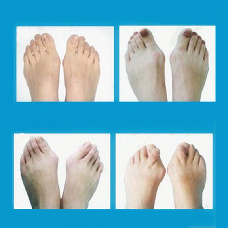 Täglich Silikon Gel Fuß Zehe Separator &Ampere; Daumen Hallux Valgus Schutz &Ampere; Ballen Erzähler Bicyclischen Daumen Orthopädische Richtige
