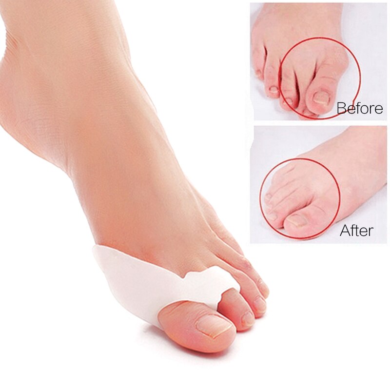 2 paar Gel Fußpflege Werkzeug Ballen Korrektor Knochen groß Zehe Schutz Hallux Valgus Haarglätter Kappe Separatoren Pedikübetreffend Korrektor