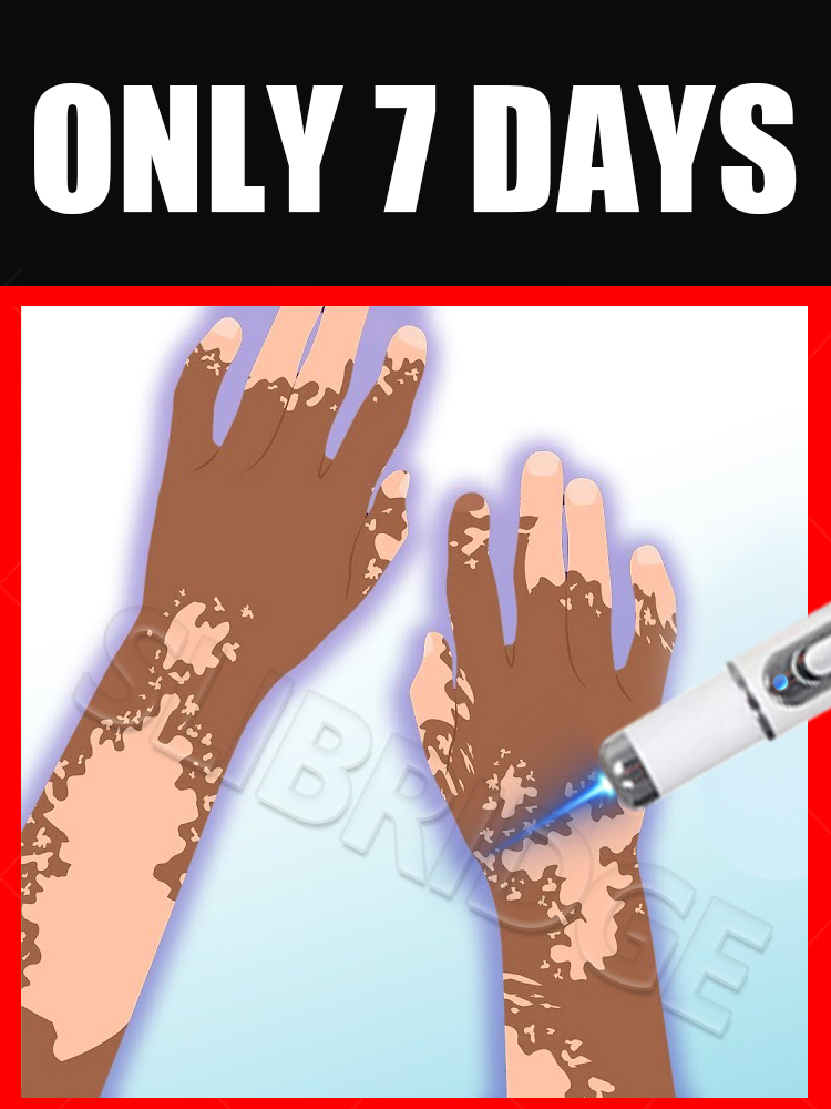 Vitiligo blåljuspenna, vitiligovårdsverktyg, unisex, generation -2, kombinationsset måltider