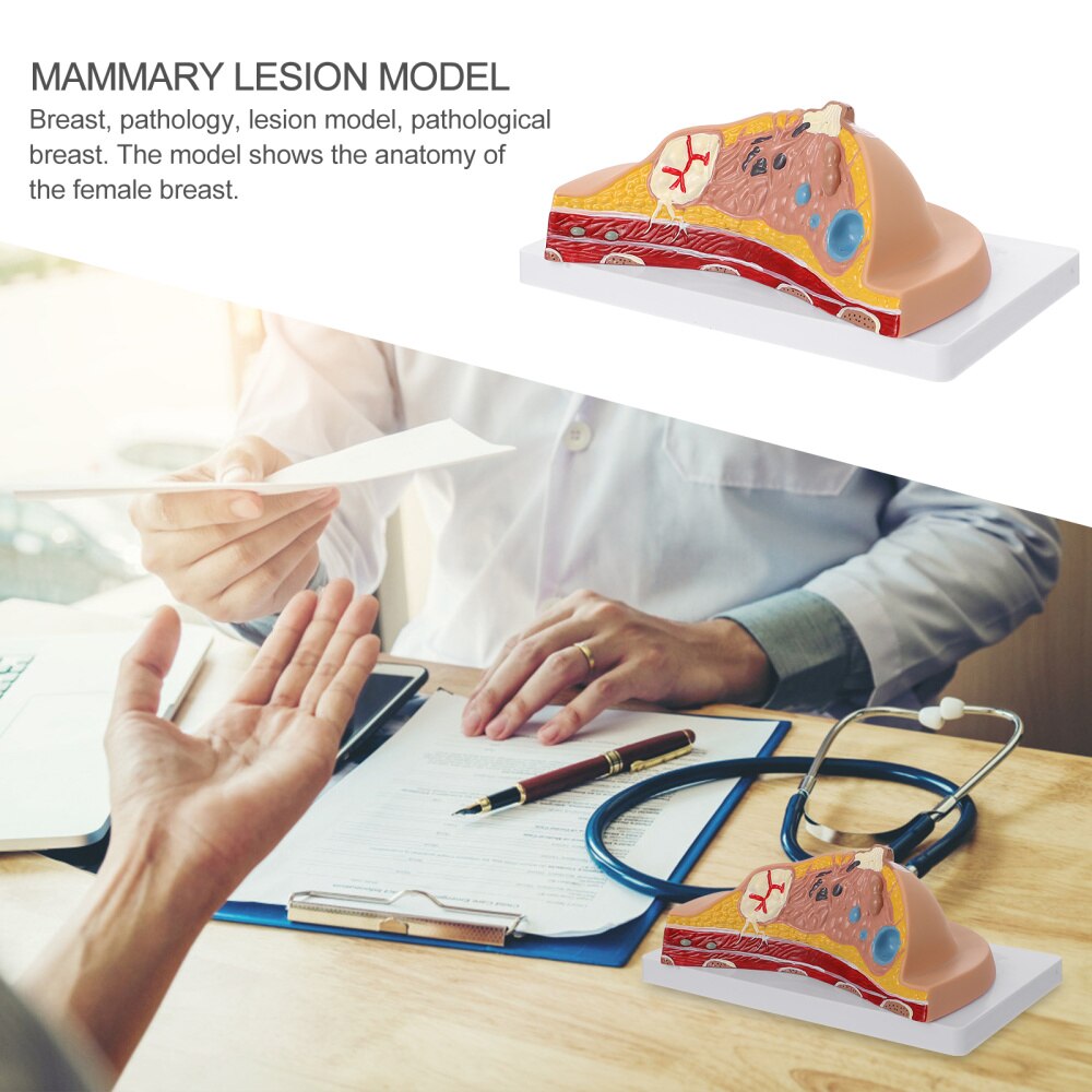 Female Breast Disease Pathology Model Udder Lesion Model Patient Communication