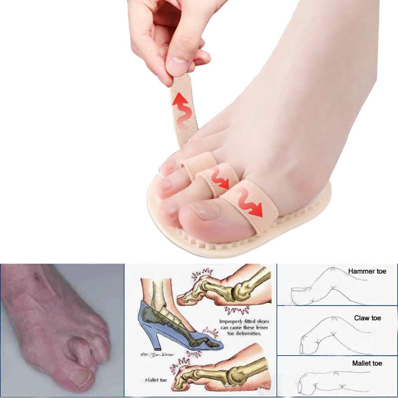 1 Pair Hammer Mallet Toe Separator Hallux Valgus Orthopedic Pads Orthotics Bending Deformation Overlap Foot Toe Correction Socks