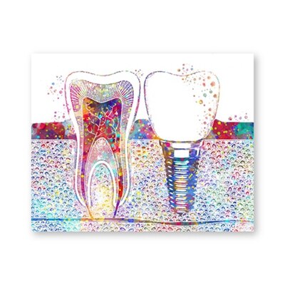 Akvarel plakat tand implantat print tandlæge tandklinik vægindretning hygiejniker kontor kunst medicin lærred maleri: 60 x 84 cm uden ramme