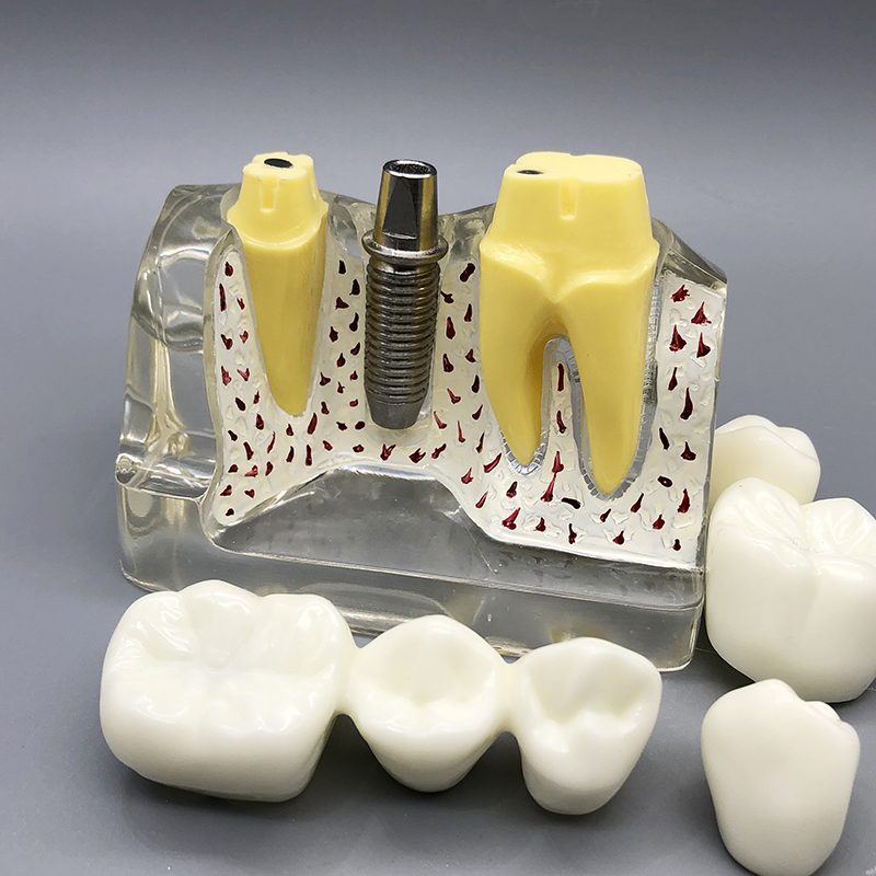 4 Times Dental Implant Analysis Crown Bridge Demonstration M2017T Dental Teeth Model Dentist Patience Model
