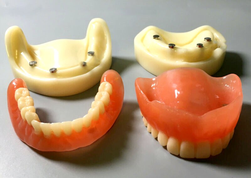 Modelo de dentadura completa Dental, accesorio magnético, estudio superior de la Mandibular