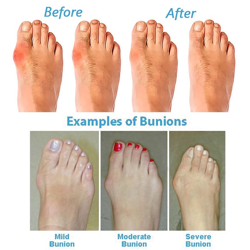 Sandalias ortopédicas correctoras de Pies Grandes suaves e informales correctoras de juanetes, sandalias para mujeres, zapatos de cuero PU, suela plana de plataforma para mujeres