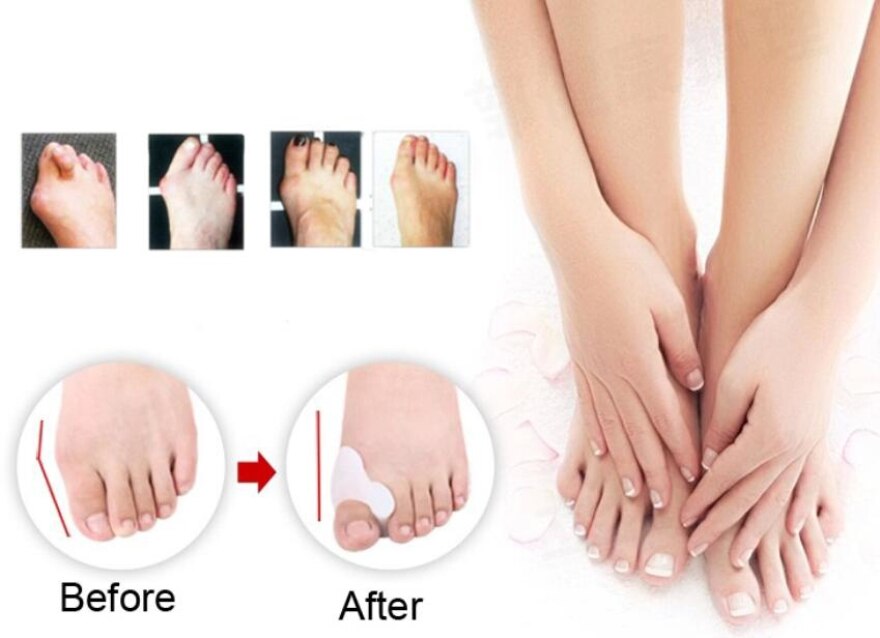 2Pcs Soft Beetle-crusher Bone Ectropion Toes Outer Appliance Silica Gel Toes Separator Feet Care Massage Products Without Box BO