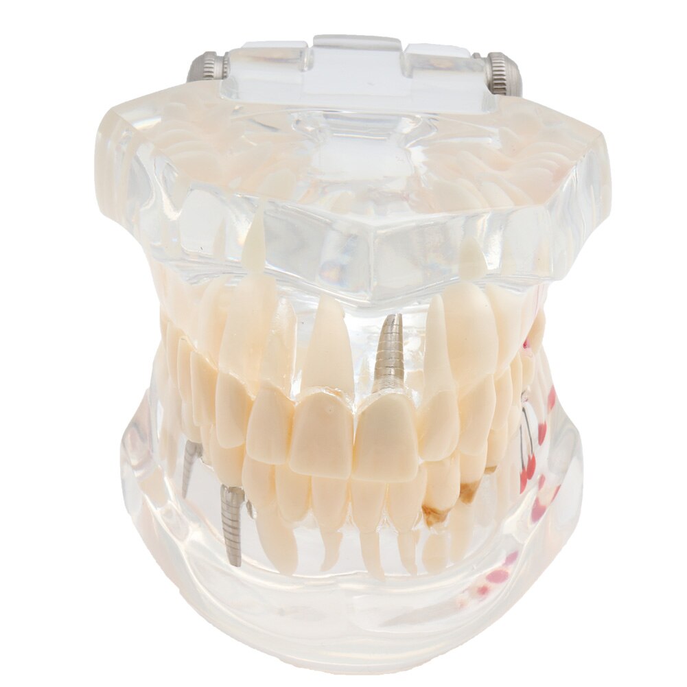 Dental Model Teeth Model Dental Teaching Model Standard Model with 32 Screw-in Teeths Demonstration Soft Hard Gum 28 24 Teeth: Implant Model