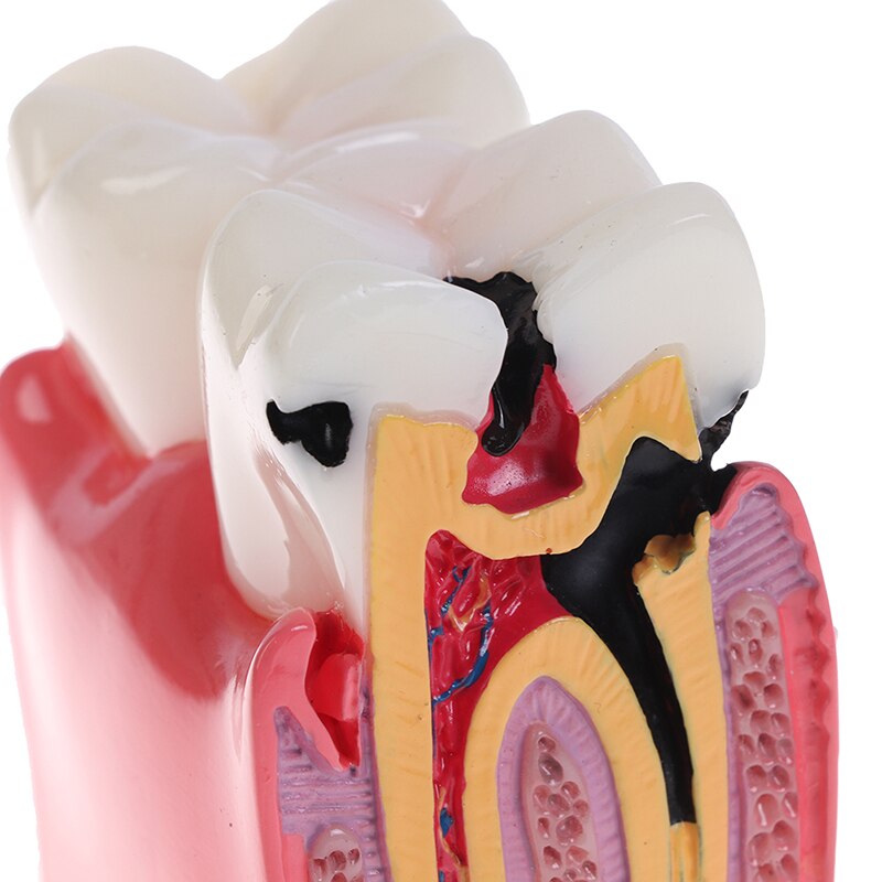 Dental Teeth Model 6 Times Caries Comparation Study Denture Tooth Models
