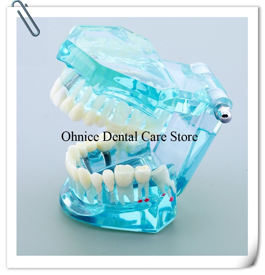 Dental Implantat Restaurierung zähne Modell M2001 Dental lehre zahn modell/Dental Labor Klinik zähne modell