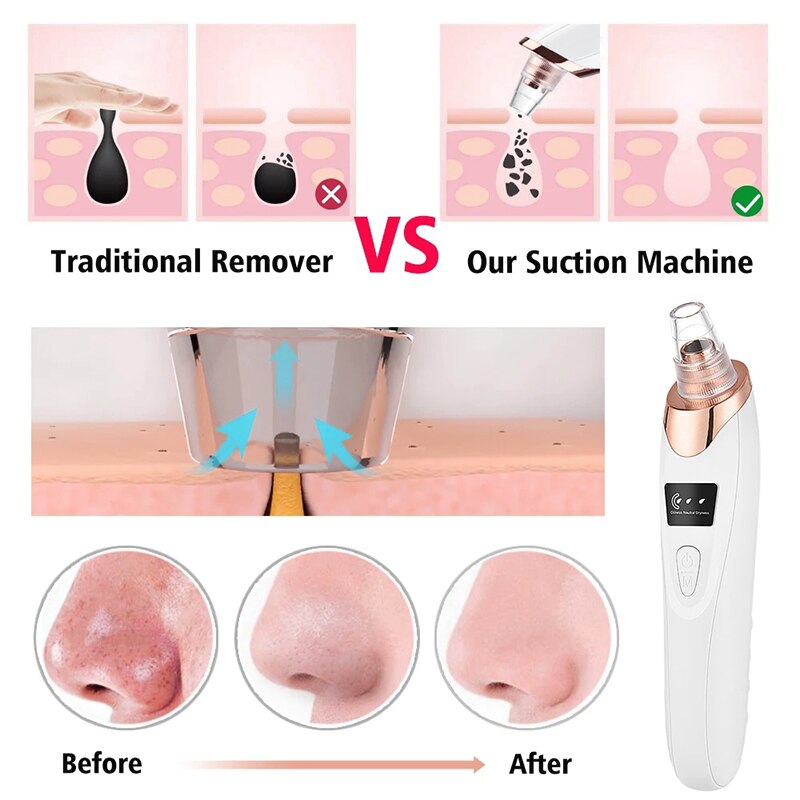 Blackhead Remover Vacuum Acne Suction Pimple Black Head Remove Skin Blackheads Cleaner Face Skin Cleaning Suction Black Points