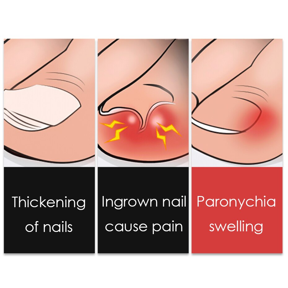 Coupe-ongles en forme de bec d&#39;aigle, pour pédicure, pince à ongles incarnés, Paronychia, ciseaux, outils de manucure, PPQ1-23