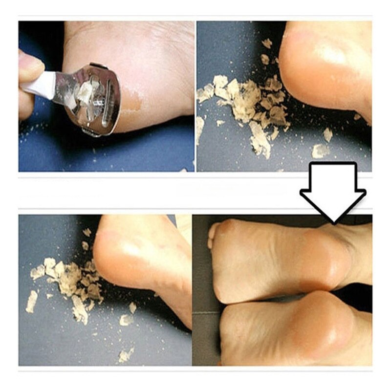 Feet Care Tool Foot Dead Skin Removal Cutter Callus Peeling Machine and Foot Care Pedicure Tools