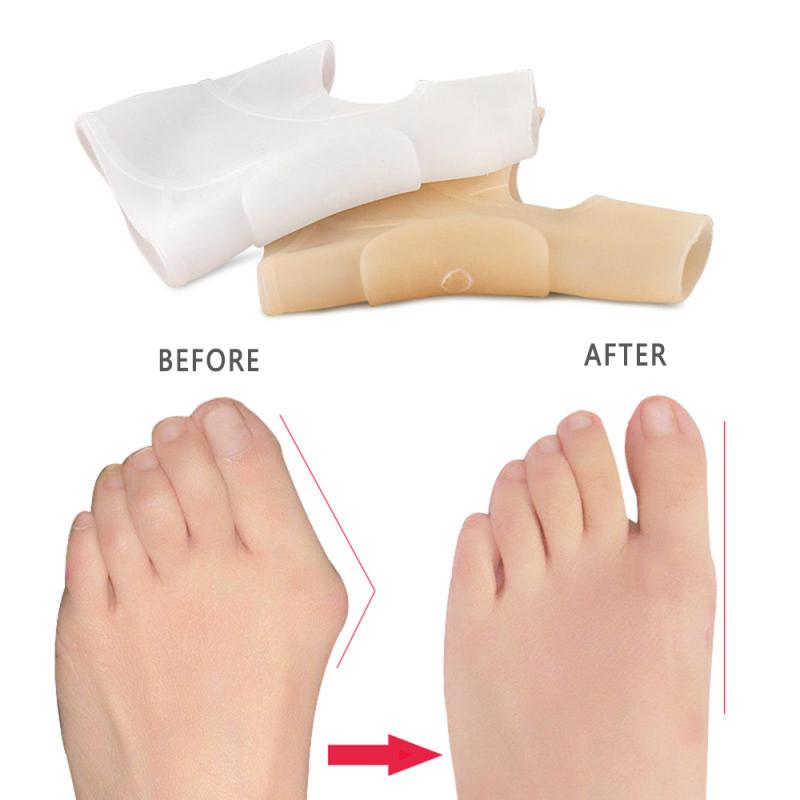 Isovarvas päällekkäisyys silikoni hallux valgus korjain varpaan erottimet nuppi korjaimet jalka sormi halkaisija varpaan suoja ortoosi