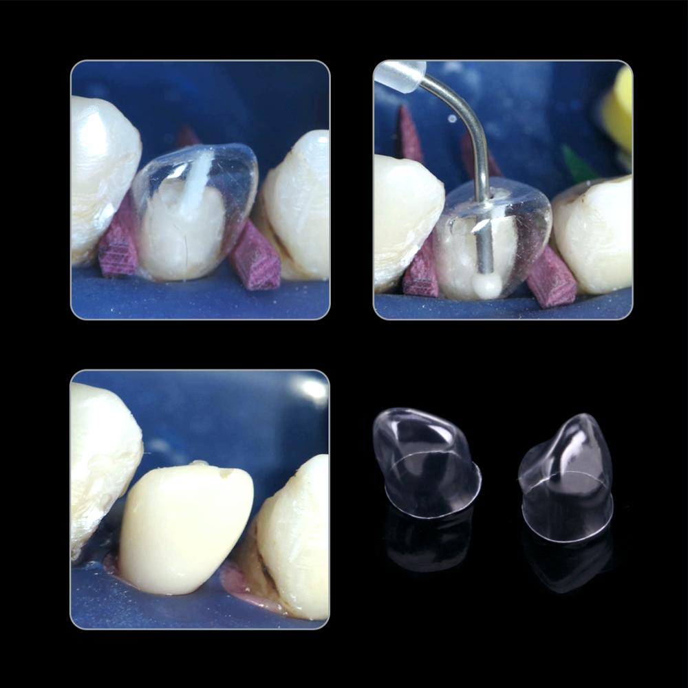 64pcs Adults Dental Anterior Transparent Crowns Dentist Tools 1.910 Anterior Transparent Crowns 64 pcs