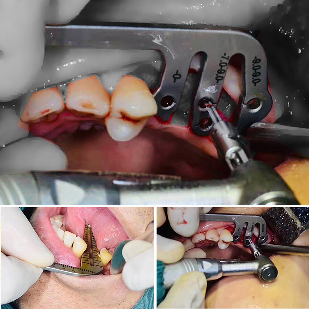 Positioning Implant Instruments Dental Implant Surgery Instrument Oral Planting Po... – Grandado