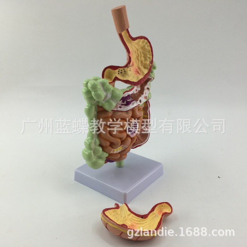Pathological model of large intestine stomach model of large intestine disease model of human colon disease