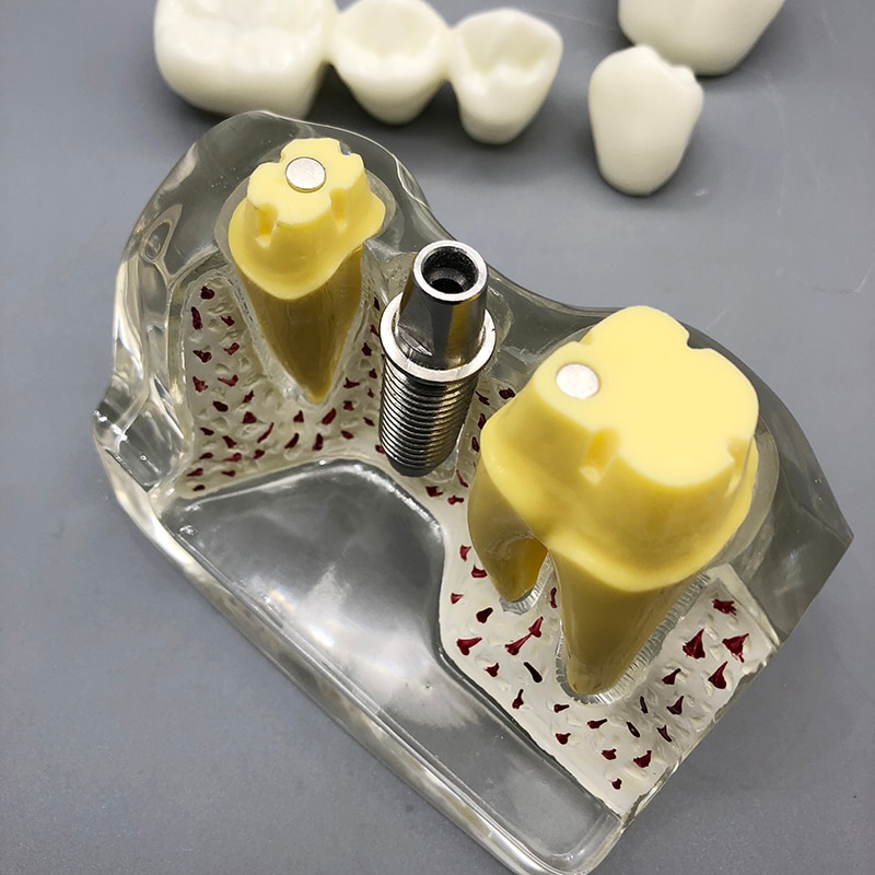 4 Times Dental Implant Analysis Crown Bridge Demonstration M2017T Dental Teeth Model Dentist Patience Model