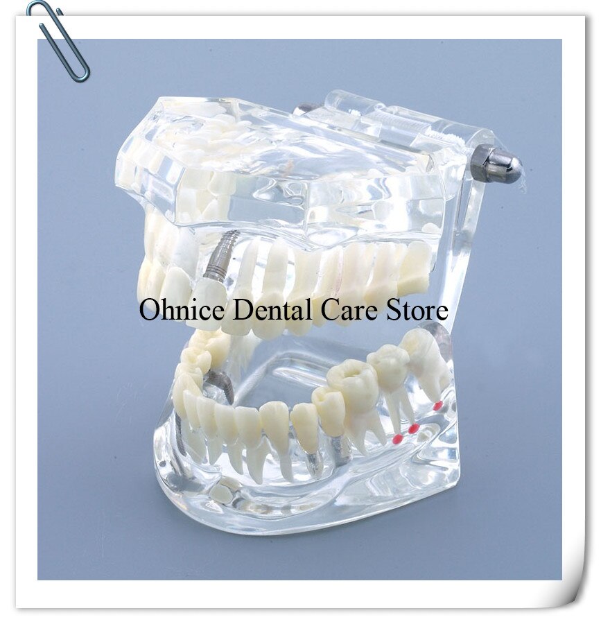 Dental Implantat Restaurierung zähne Modell M2001 Dental lehre zahn modell/Dental Labor Klinik zähne modell