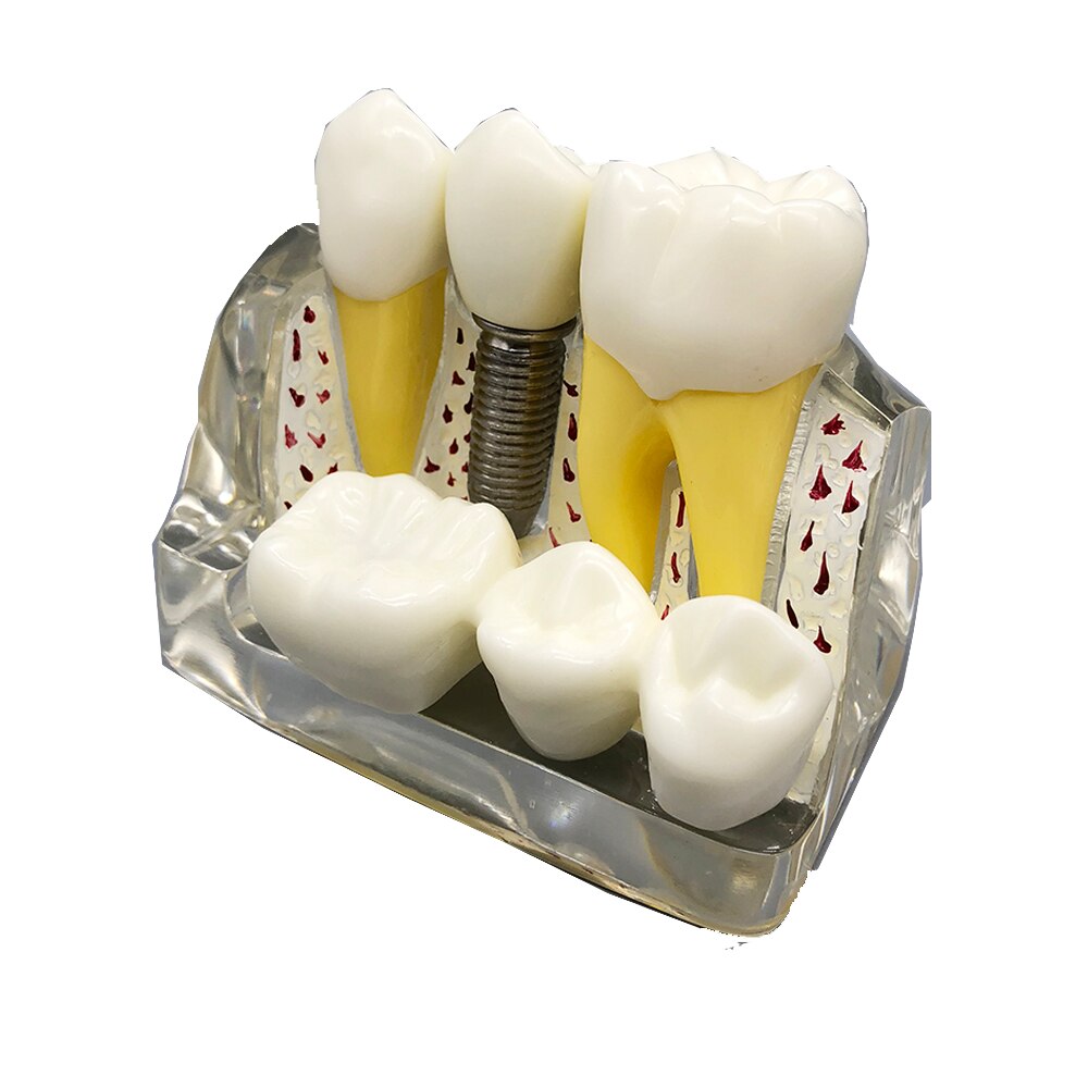 Transparant 4 Keer Dental Implant Analyse Crown Bridge Demonstratie Dental Tanden Model Tandarts Geduld Model M2017T