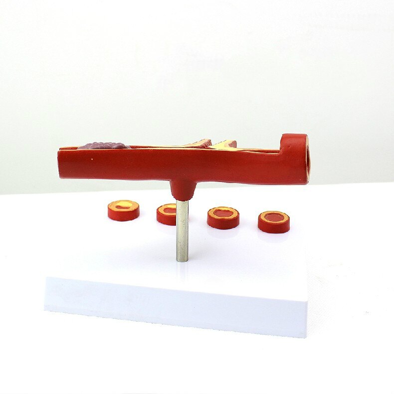 10X Enlarge Human Arterial Coronary Arteriosclerosis Atherosclerosis Coronary Model Cross Section Heart Disease Thrombus Model