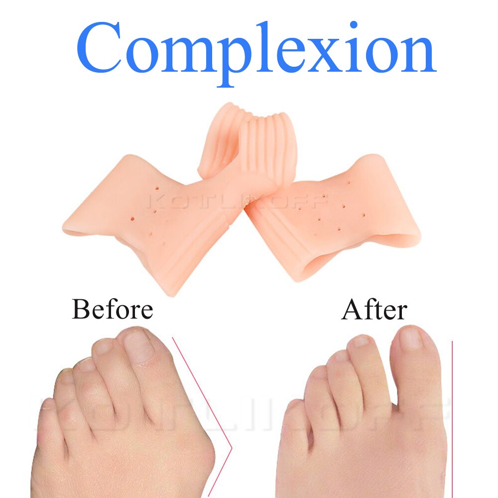 Grote Teen Overlap Siliconen Hallux Valgus Corrector Teenseparators Bunion Correctoren Voet Vinger Splitter Teen Bescherming Orthese: Complexion