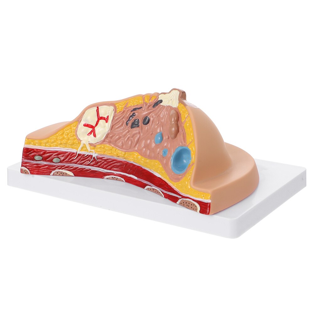 Female Breast Disease Pathology Model Udder Lesion Model Patient Communication