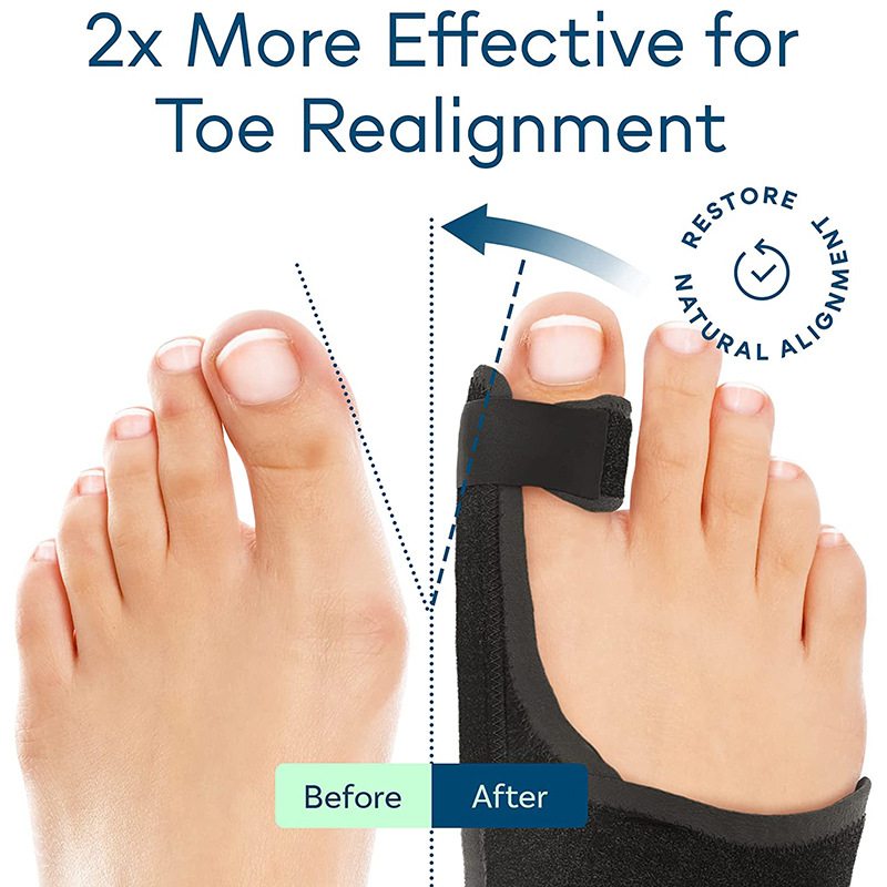 Ortopedisk hallux valgus-korreksjon, stortåseparator, smertelindring, ikke-kirurgisk hallux valgus-korreksjon, hammertårettingsverktøy