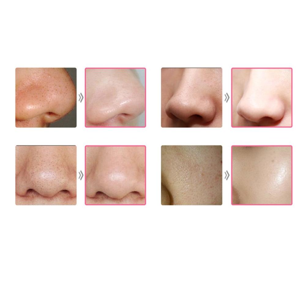 Blackhead Remover Face Deep Nose Cleaner T Zone Pore Acne Pimple Removal Vacuum Suction Facial Diamond Beauty Clean Skin Tool