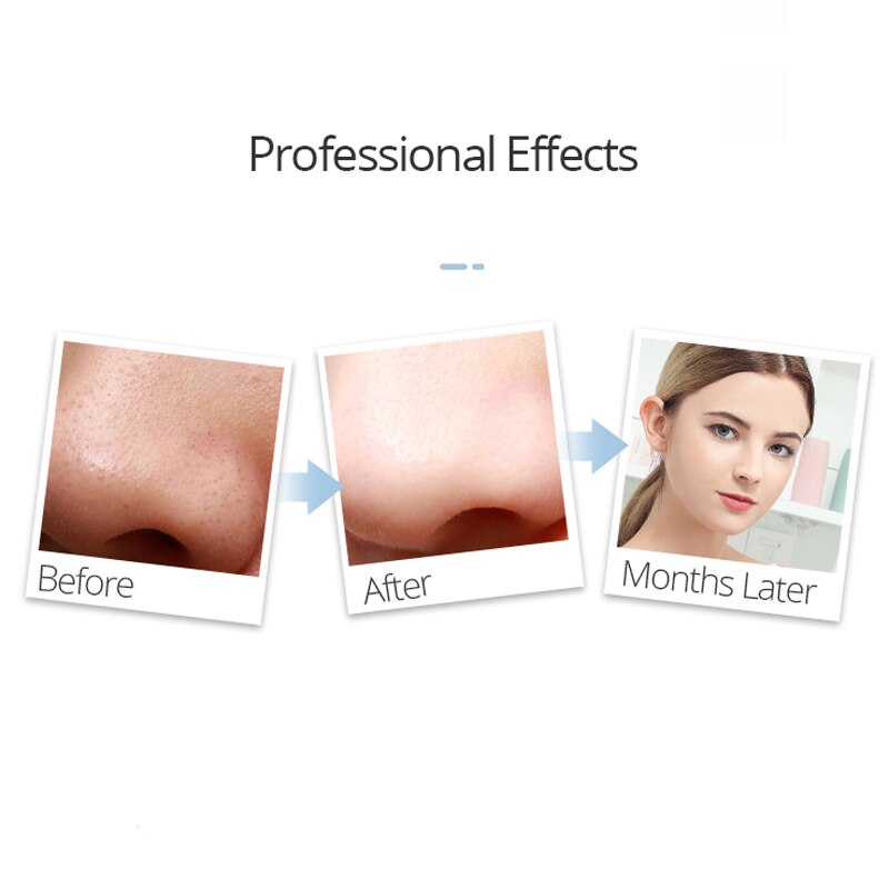 3 Vacuüm Zuigkoppen Multifunctionele Gezicht Reinigingsapparaat Elektrische Vacuüm Black Head Remover Lichter Fijne Rimpels Olie Controle