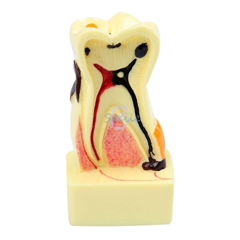 1pcs Dental Tooth Neuroanatomy Teaching Model 4 times transparent molar profile model with nerve Pathological Tooth Model