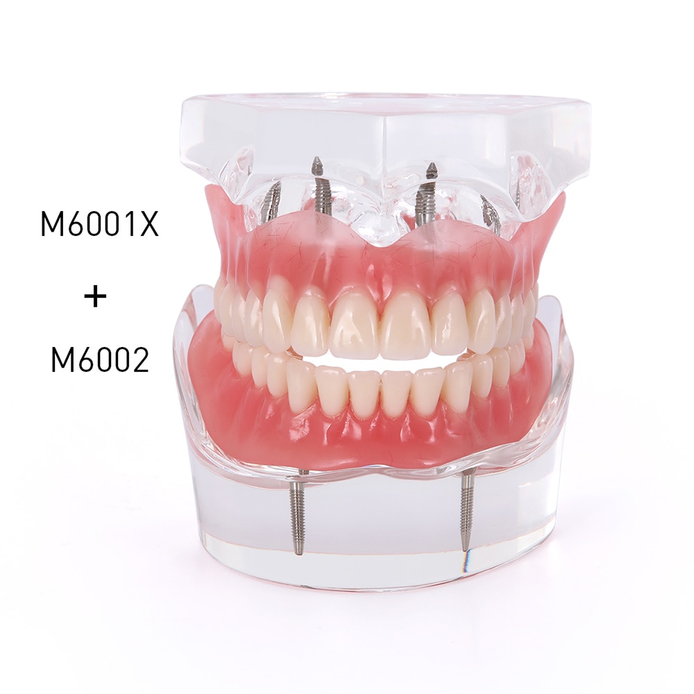 Dental Implant Teeth Model Removable Interior Mandibular Demo Overdenture With Implants upper/Lower for Tooth Teaching Study